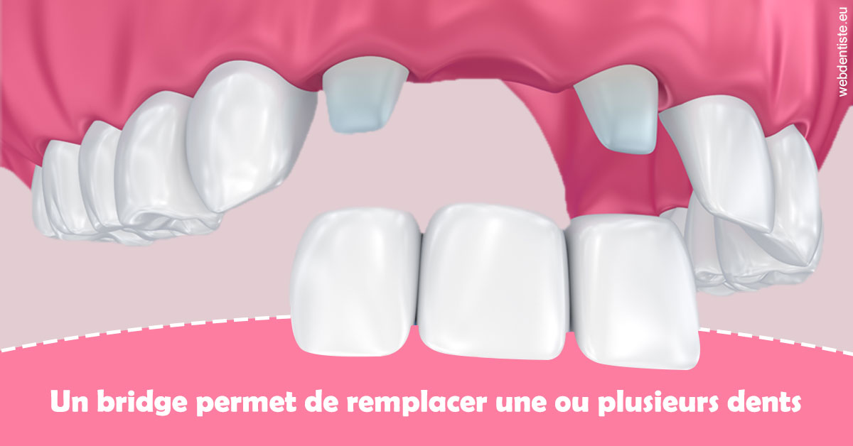 https://scp-aeberhardt-jahannot-pomel.chirurgiens-dentistes.fr/Bridge remplacer dents 2
