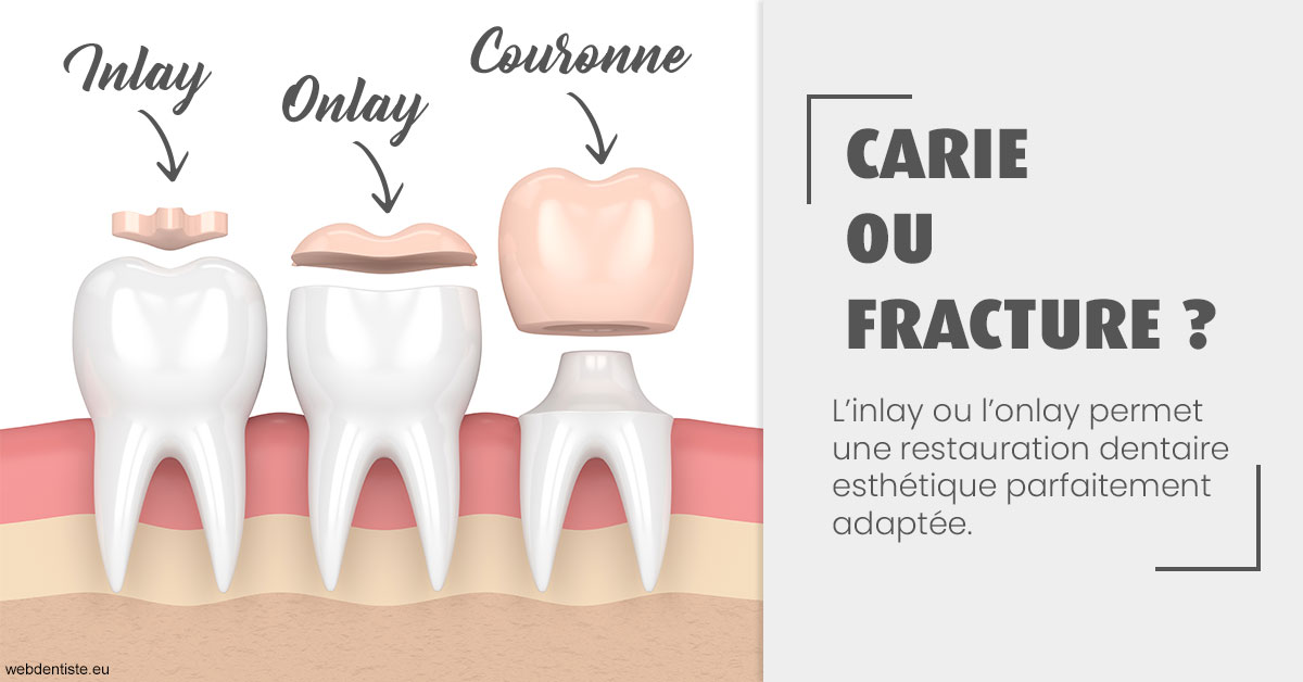 https://scp-aeberhardt-jahannot-pomel.chirurgiens-dentistes.fr/T2 2023 - Carie ou fracture 1