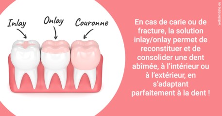 https://scp-aeberhardt-jahannot-pomel.chirurgiens-dentistes.fr/L'INLAY ou l'ONLAY 2