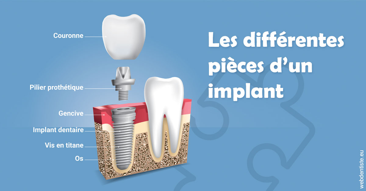 https://scp-aeberhardt-jahannot-pomel.chirurgiens-dentistes.fr/Les différentes pièces d’un implant 1